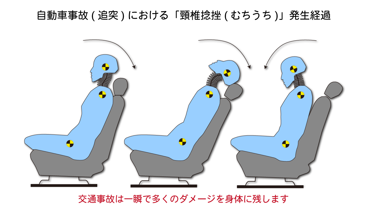 自動車事故(追突)における「頸椎捻挫(むちうち)」発生経過図